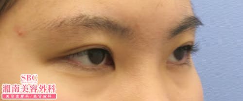 【女性・目元】クイックコスメティーク・ダブルNeo・クイックコスメティーク・シングルNeo・目頭切開プレミアム_before