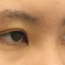 【女性・目元】クイックコスメティーク・ダブルNeo・クイックコスメティーク・シングルNeo・目頭切開プレミアム_before