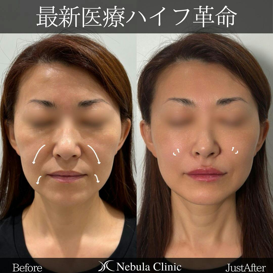 【女性・顔・小鼻・法令線・唇】医療ハイフ、ヒアルロン酸注入(貴族・法令線・唇)_before_aftar