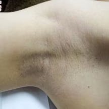 【女性・多汗症】ベイザーシェービング法、シェービング法、完全摘出法_before