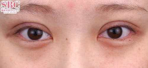 【20代女性・目元】クイックコスメティーク・トリプルNeo_0day