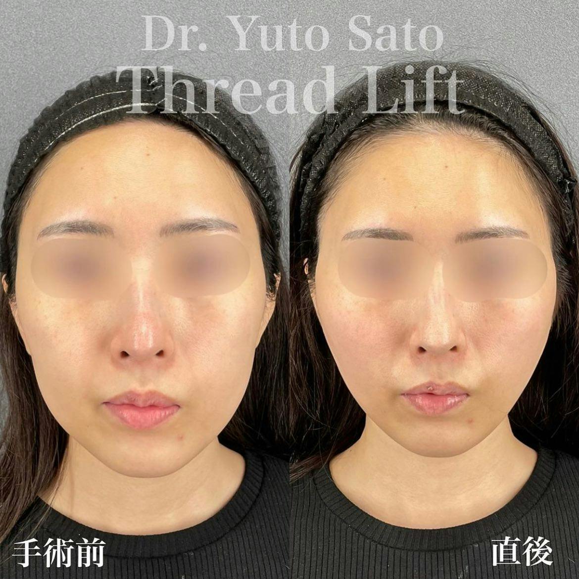 【女性・たるみ】糸リフト_before_aftar