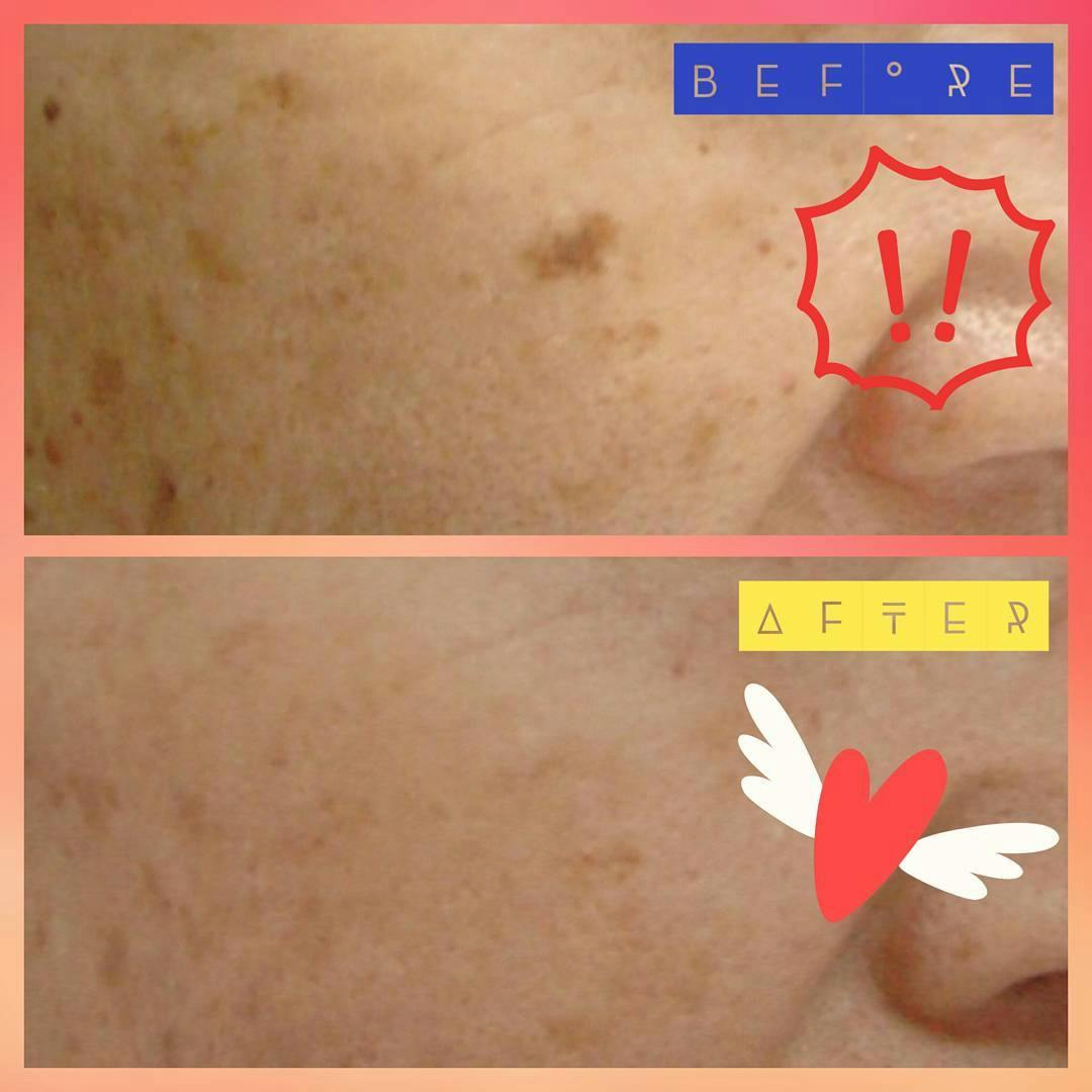 【女性・シミ】アレキサンドライトレーザー_before_aftar