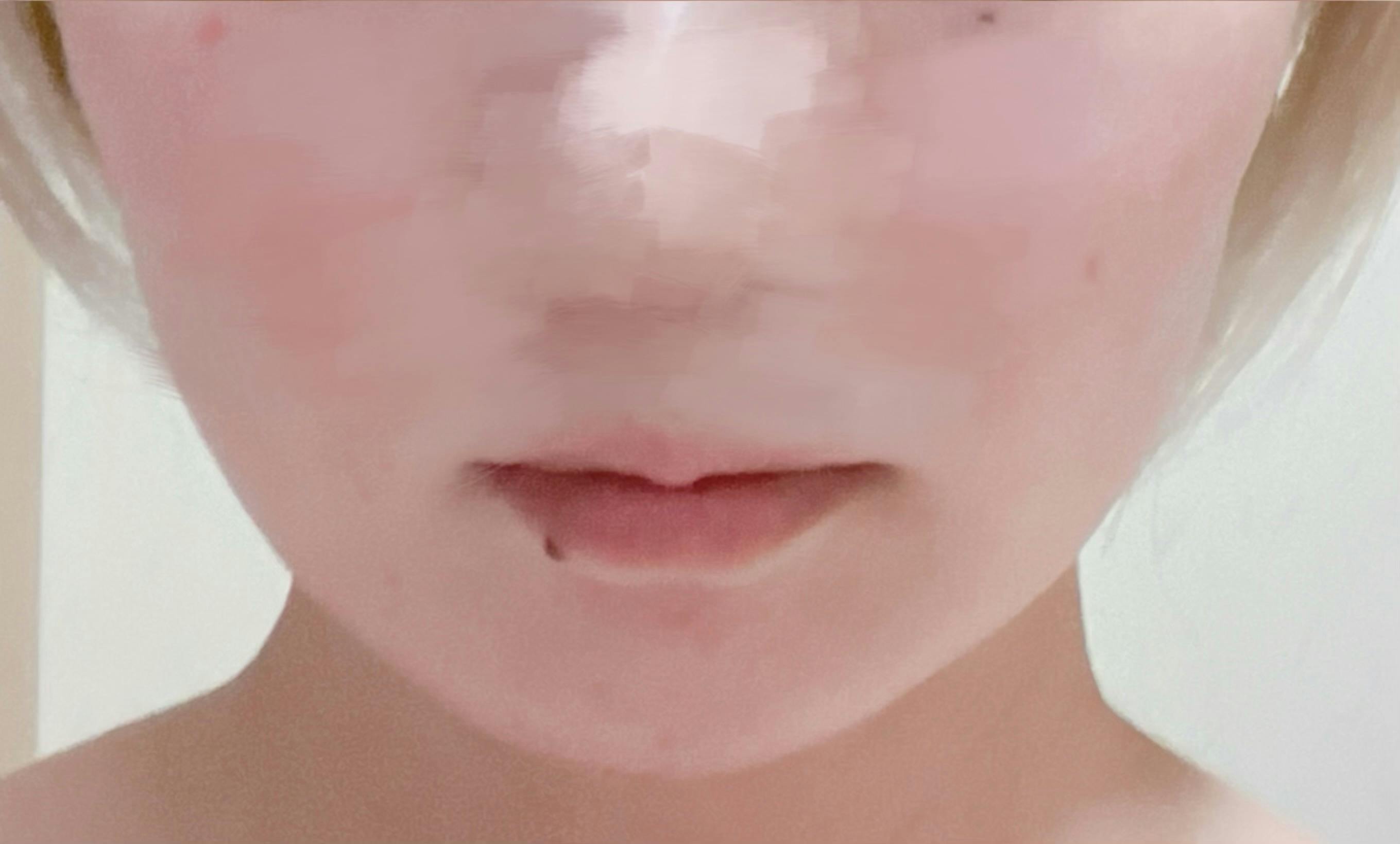 フェイススキンクリニック(FACE SKIN CLINIC)で顎ヒアルロン酸注入(ボラックス)を受けたumさんの写真