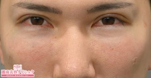 【20代男性・目元】目の下の切らないクマ・たるみ（ふくらみ）取り ナチュラル脂肪注射コンデンスリッチ ナチュラル脂肪注射ナノリッチ_after