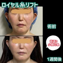 【女性・小顔】ロイヤル糸リフト_before_aftar