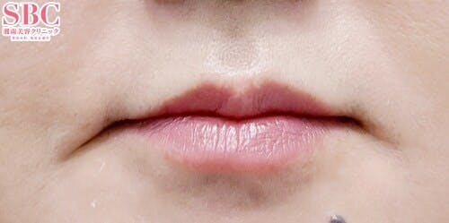 【40代女性・唇】コンデンスリッチフェイス脂肪注入全顔入れ放題_after