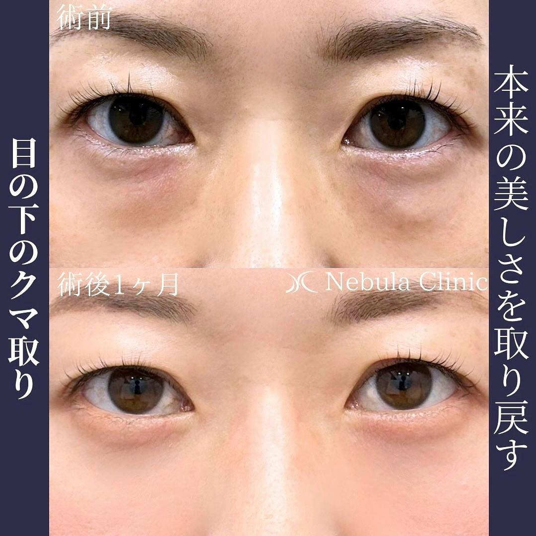 【女性・目元】二重埋没法_before_aftar