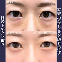 【女性・目元】二重埋没法_before_aftar