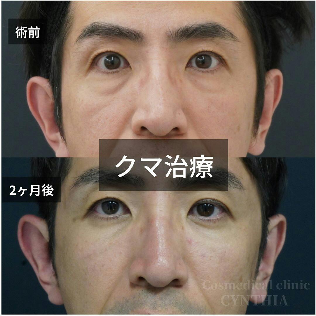【40代男性・目元】目の下のクマ・たるみ取り・マイクロコンデンスリッチファット注入_before_aftar