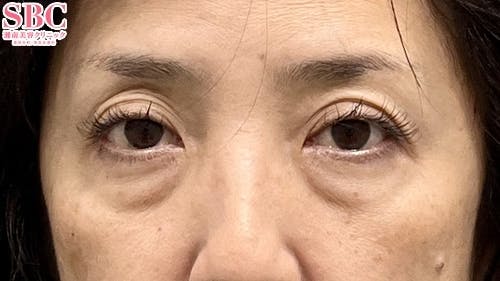 【50代女性・目元】ナチュラル脂肪注射コンデンスリッチ ナチュラル脂肪注射ナノリッチ 目の下の切らないクマ・たるみ（ふくらみ）取り_before