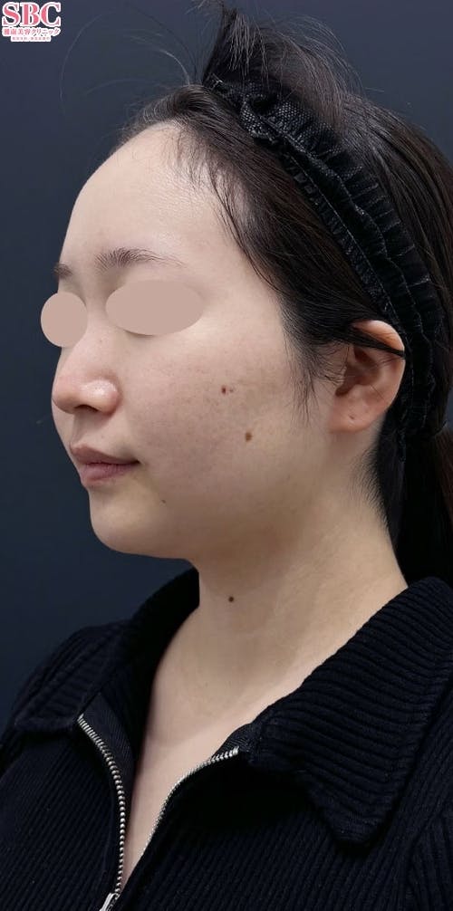 【20代女性・輪郭】根こそぎVASER脂肪吸引_before