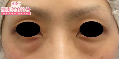 【女性・目元】目の下の切らないクマ・たるみ（ふくらみ）取り・ナチュラル脂肪注射コンデンスリッチ・ナチュラル脂肪注射_before