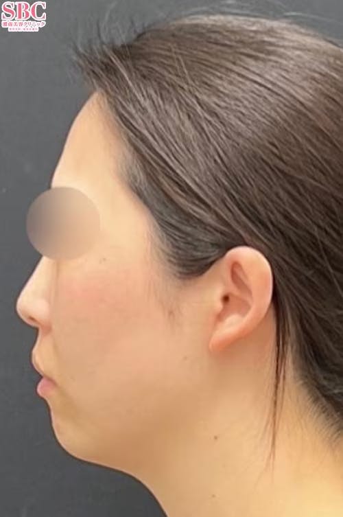 【30代女性・顔】根こそぎVASER脂肪吸引、あざむくみ抑制ドレナージュ、プリマリフト_before