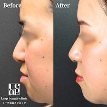 【20代女性・鼻】鼻尖形成・鼻中隔延長・耳介軟骨移植_before_aftar