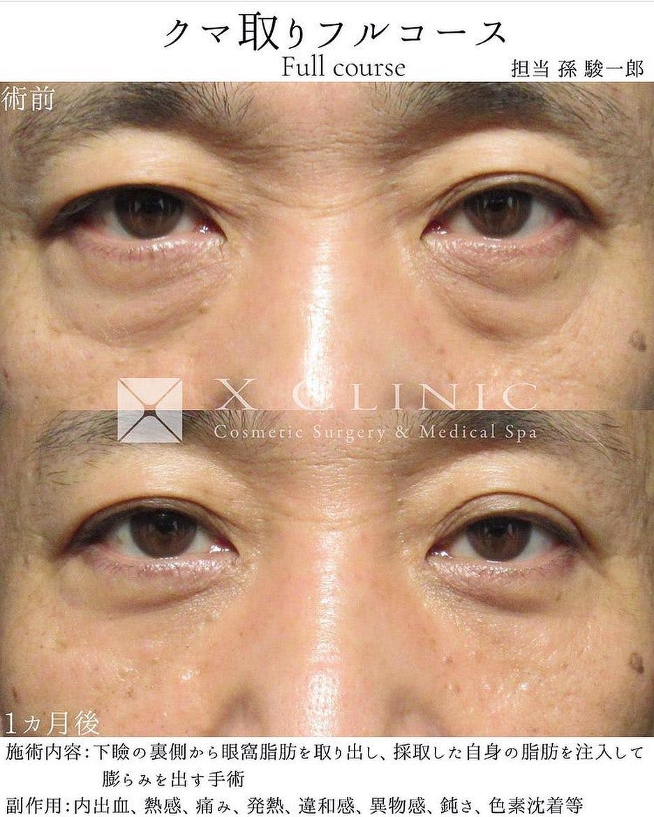 【男性・目元】クマ取りフルコース_before_aftar