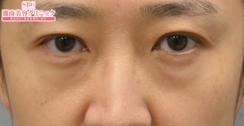 【40代女性・目元】目の下の切らないクマ・たるみ（ふくらみ）取り ナチュラル脂肪注射コンデンスリッチ ナチュラル脂肪注射ナノリッチ_before