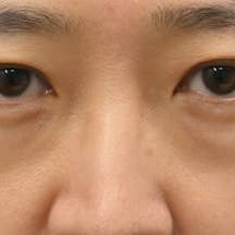 【40代女性・目元】目の下の切らないクマ・たるみ(ふくらみ)取り ナチュラル脂肪注射コンデンスリッチ ナチュラル脂肪注射ナノリッチ_before