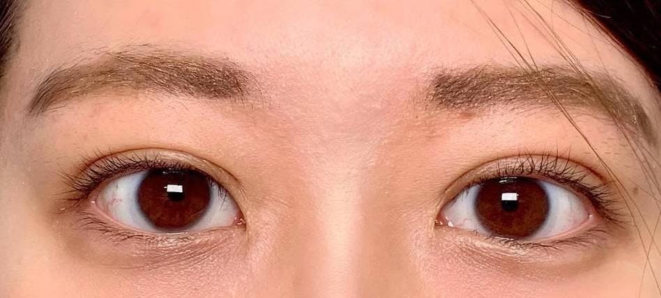湘南美容クリニック 横浜院で二重埋没法：自然癒着法を受けたみなもさんの写真