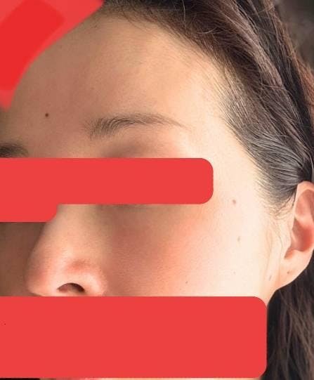 e-clinic(eクリニック) 東京院でクマ取り・目の下のたるみ取り：非切開による脂肪除去を受けたみぽりんさんの写真