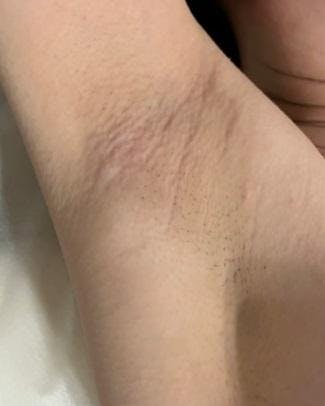 美容皮膚科エルムクリニック 福岡院で医療レーザー脱毛：全身脱毛 + VIOを受けたもにちゃんさんの写真