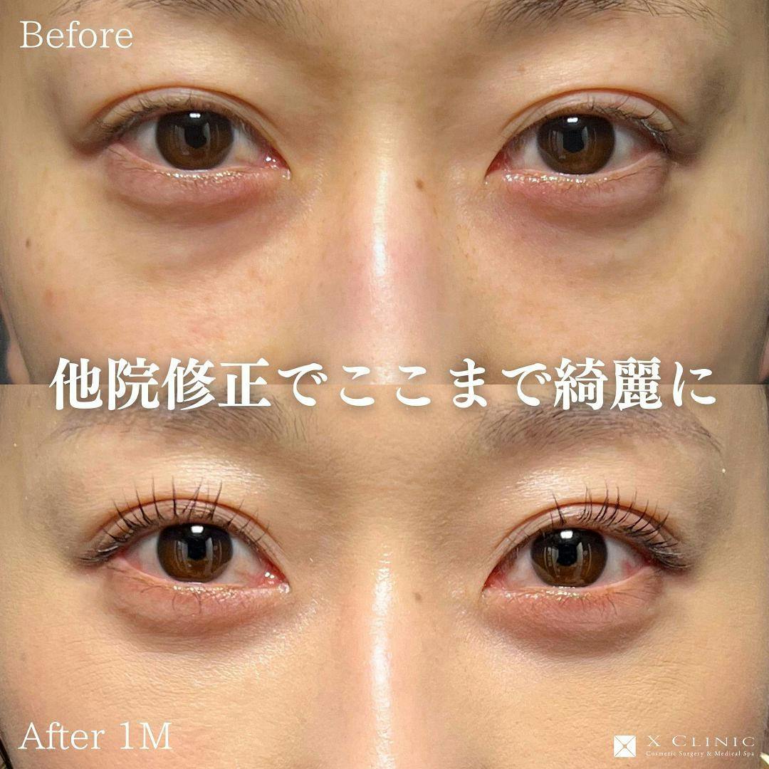 【30代女性・目元】クマ取りフルコース(クマ取り＋コンデンス＋ナノファット)_before_aftar