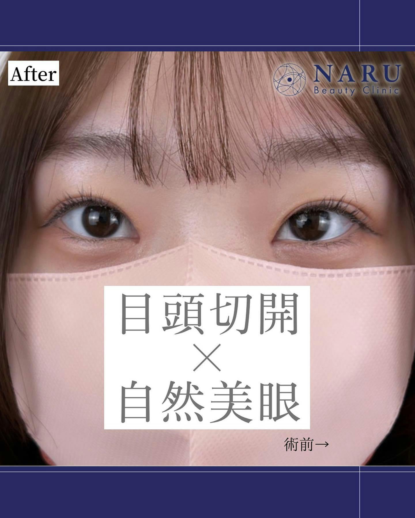 【女性・目元】二重埋没法_after