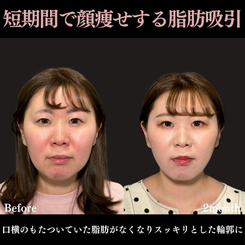 【30代女性・頬・顎下】脂肪吸引クイック（頬・顎下）_before_aftar