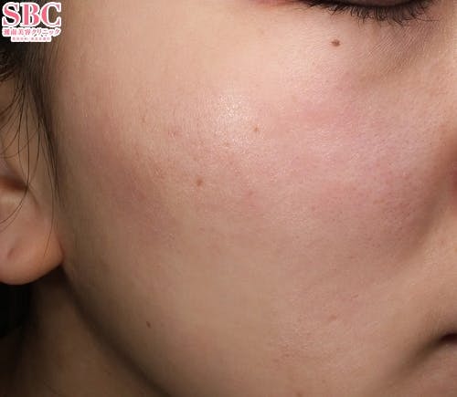 【女性・肌】ヒアルロン酸 ヒアルロン酸ジュビダームビスタ バイクロスシリーズ_before