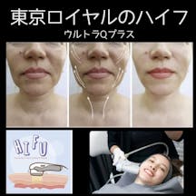 【女性・たるみ】ハイフ(ウルトラセルQプラス)_before_aftar