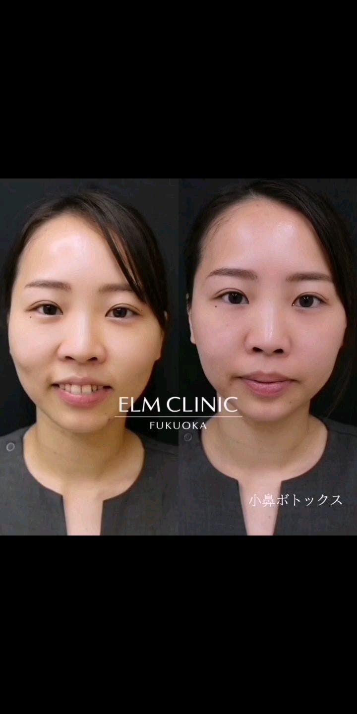 【女性・鼻】小鼻ボトックス_before_aftar