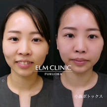 【女性・鼻】小鼻ボトックス_before_aftar