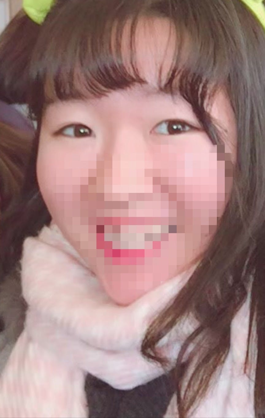 湘南美容クリニック 川崎院でを受けたhanaさんの写真