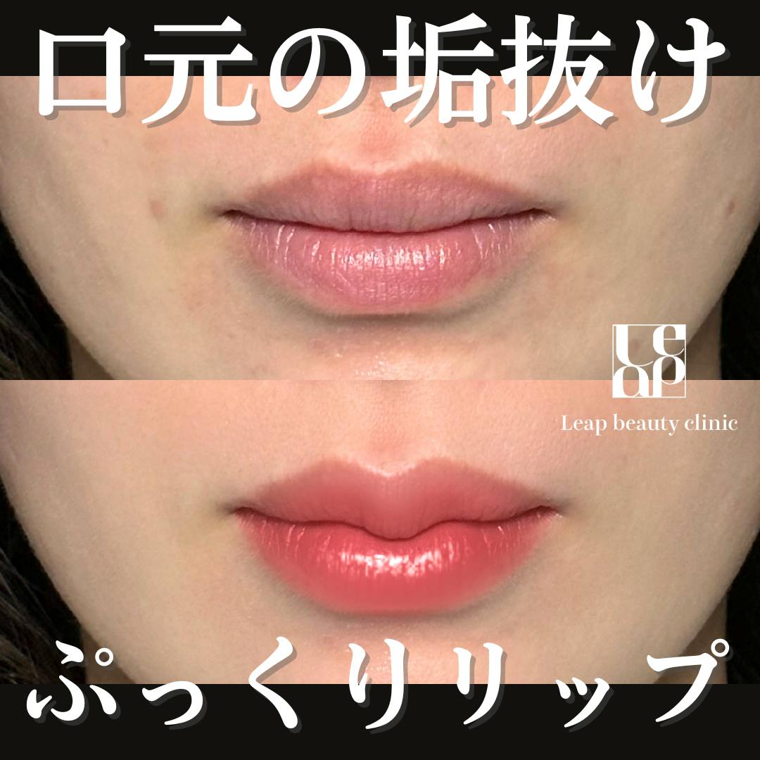 【20代女性・唇】M字リップ形成術_before_aftar