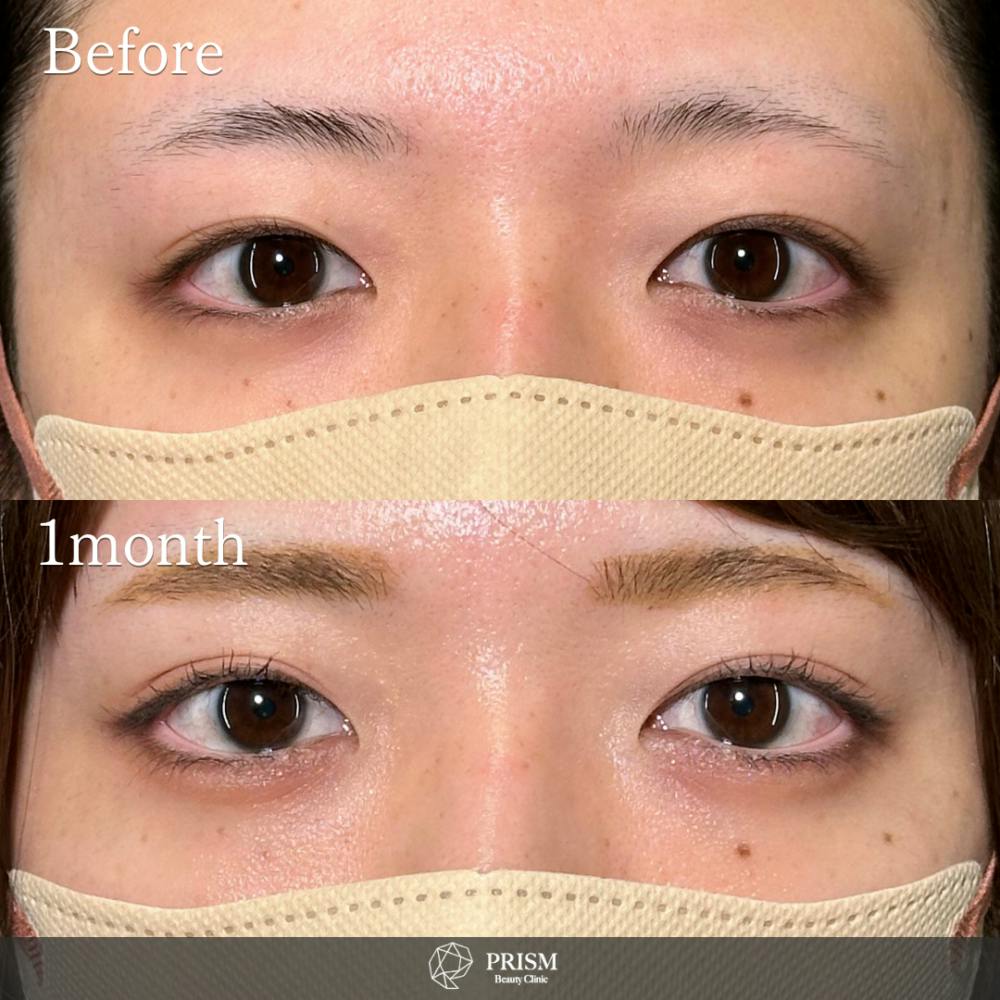 【20代女性・目】PRISM 1day二重埋没 プレミアム 線留め (自然癒着法)_before_aftar