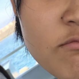 吉田皮ふ科・形成外科クリニックでほくろ取りを受けたななこさんの写真