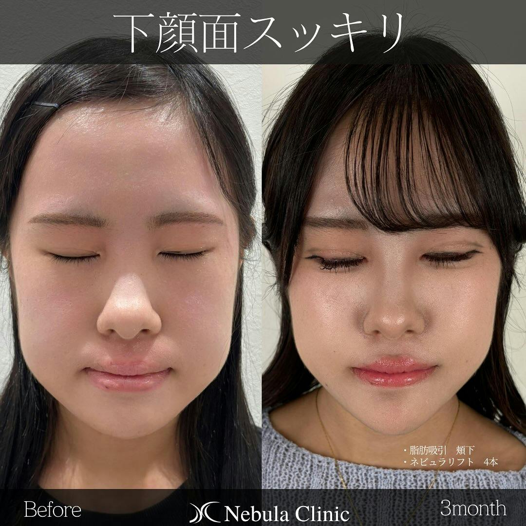 【女性・輪郭】脂肪吸引（頬下）、糸リフト_before_aftar