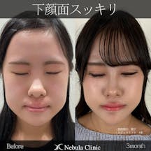 【女性・輪郭】脂肪吸引(頬下)、糸リフト_before_aftar