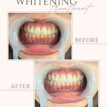 【20代女性・歯】ポリリンホワイトニング_before_aftar