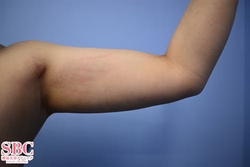 【女性・二の腕】根こそぎVASER脂肪吸引、ライポマティック脂肪吸引、Aquicell（アキーセル）脂肪吸引_aftar