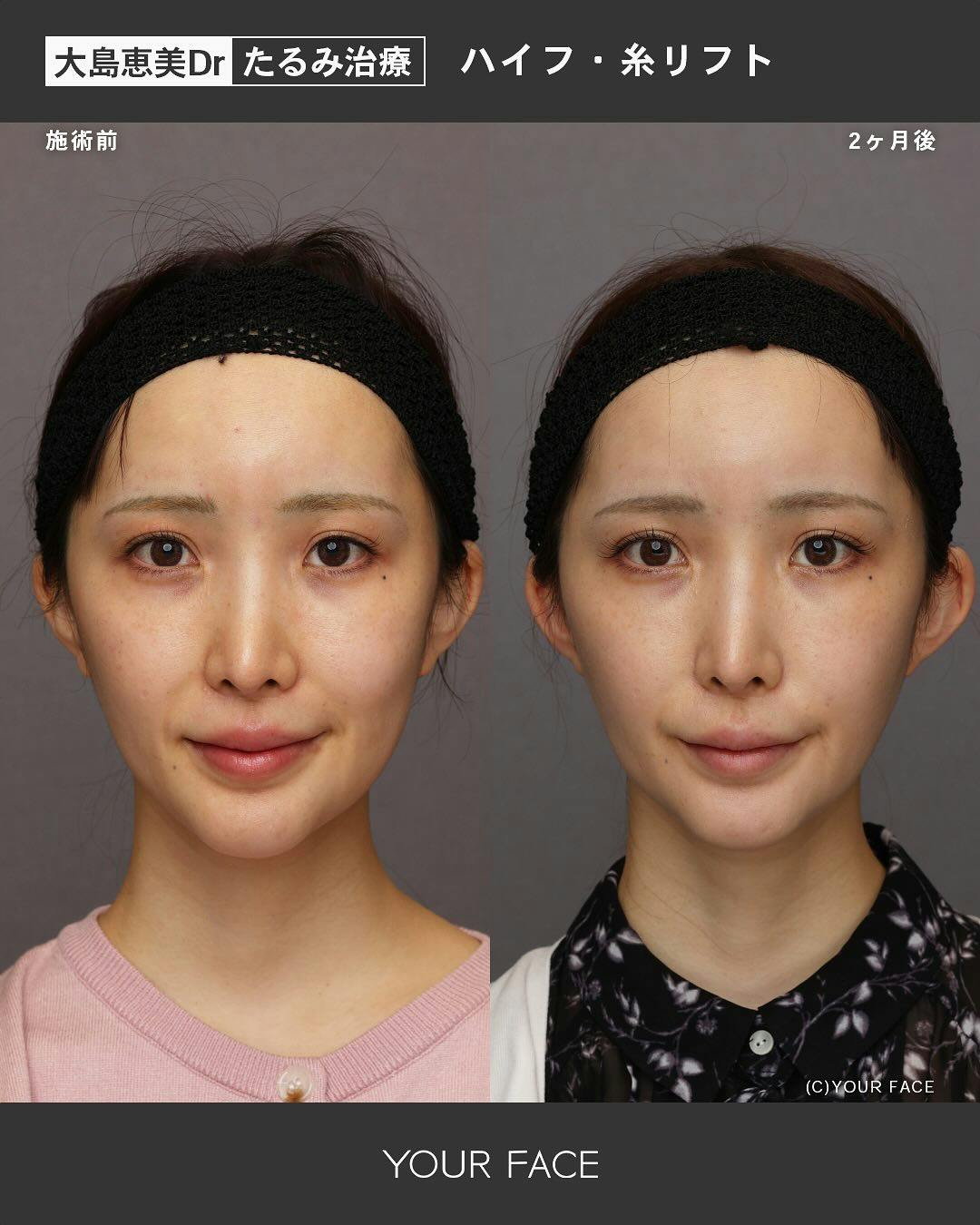 【女性・たるみ】ハイフ·糸リフト_before_aftar