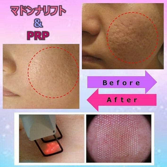 【女性・ニキビ痕】マドンナリフト・ＰＲＰ_before_aftar