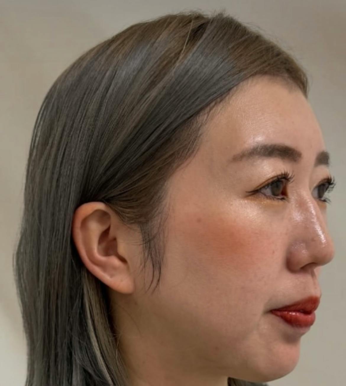 【女性・フェイスライン】アルテミスリフト_a1