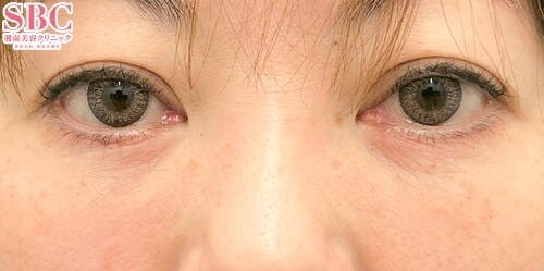 【女性・クマ】切開ハムラ(表ハムラ)法_1month