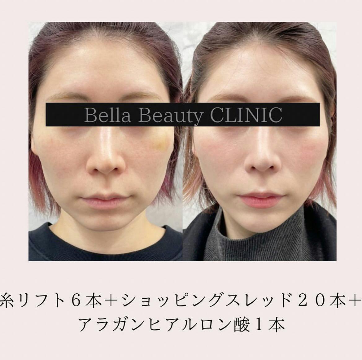 【女性・たるみ】糸リフト（フェイスライン）_before_aftar