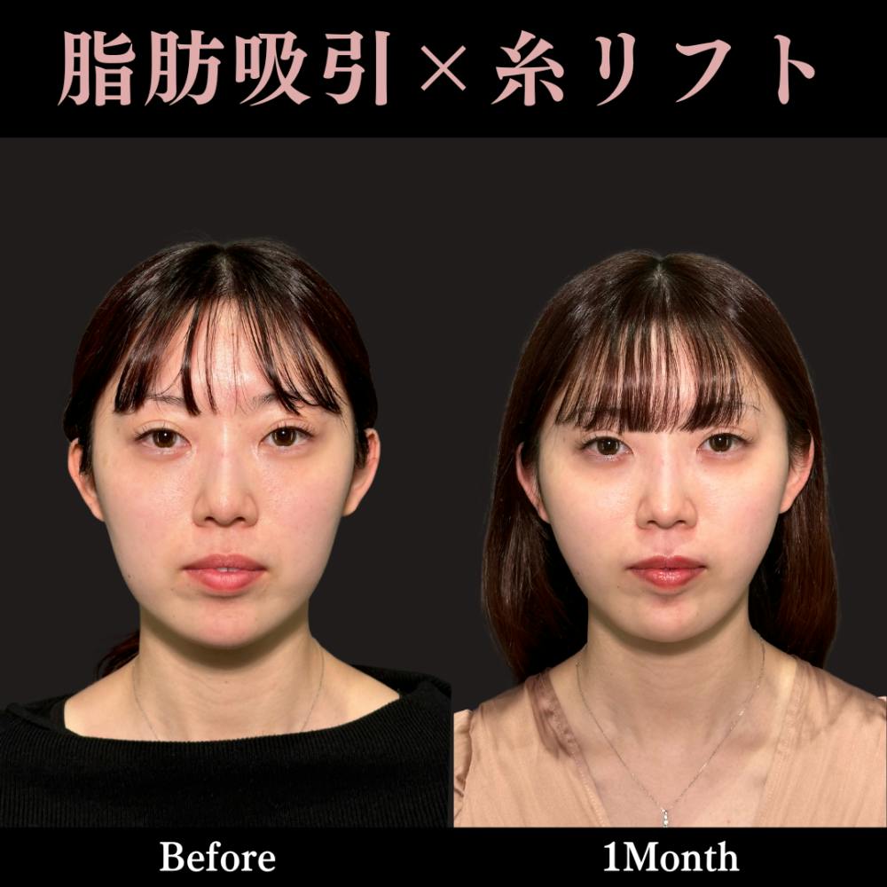 【20代女性・顔】脂肪吸引+糸リフト_before_aftar