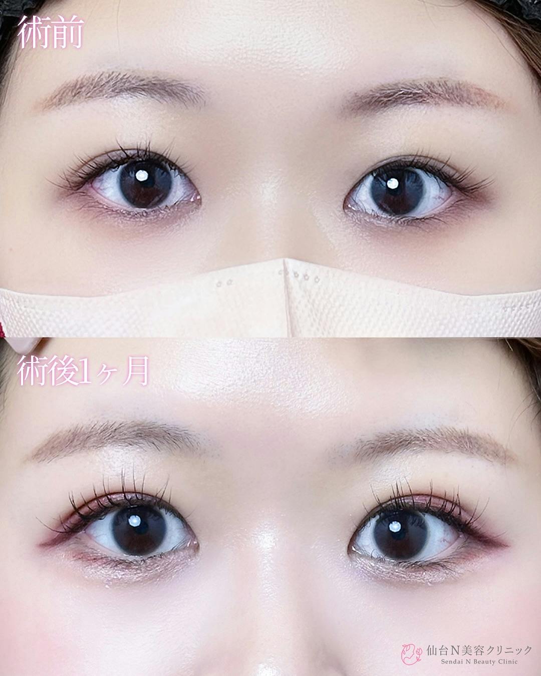 【女性・目元】二重埋没法（シークレットトリプル）_before_aftar