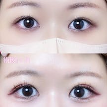 【女性・目元】二重埋没法(シークレットトリプル)_before_aftar
