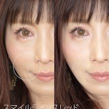 【女性・ほうれい線】スマイルラインスレッド_before_aftar