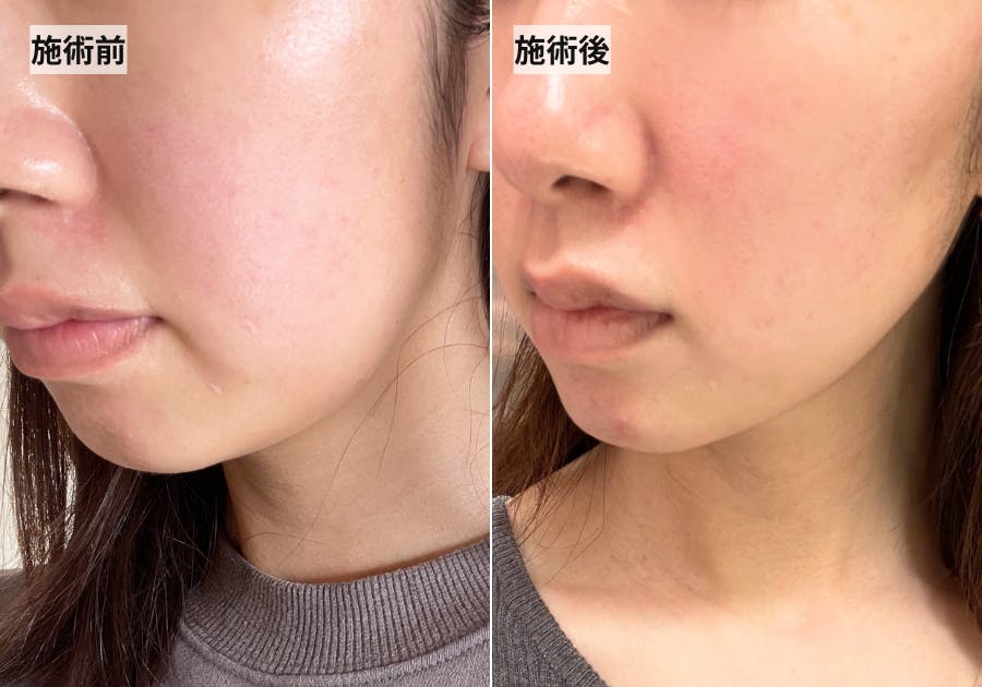 アクアピール（ハイドラフェイシャル） ハイドラシャワー（アクアピーリング） | はなふさ皮膚科・美容皮膚科